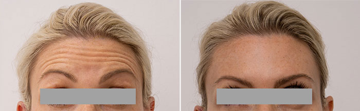 Anti Wrinkle Injections Melbourne, Anti Wrinkle Treatment